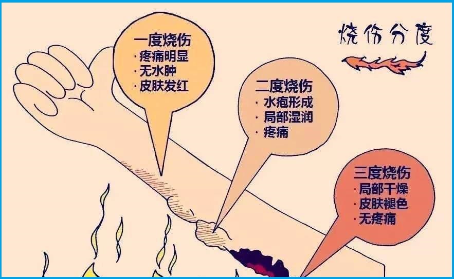  烧伤
